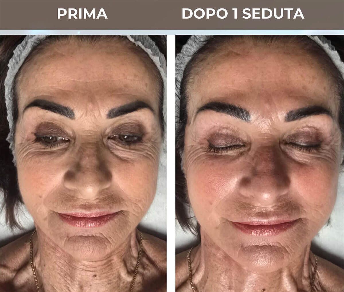 Trattamento viso e mani con fototipo a Roma